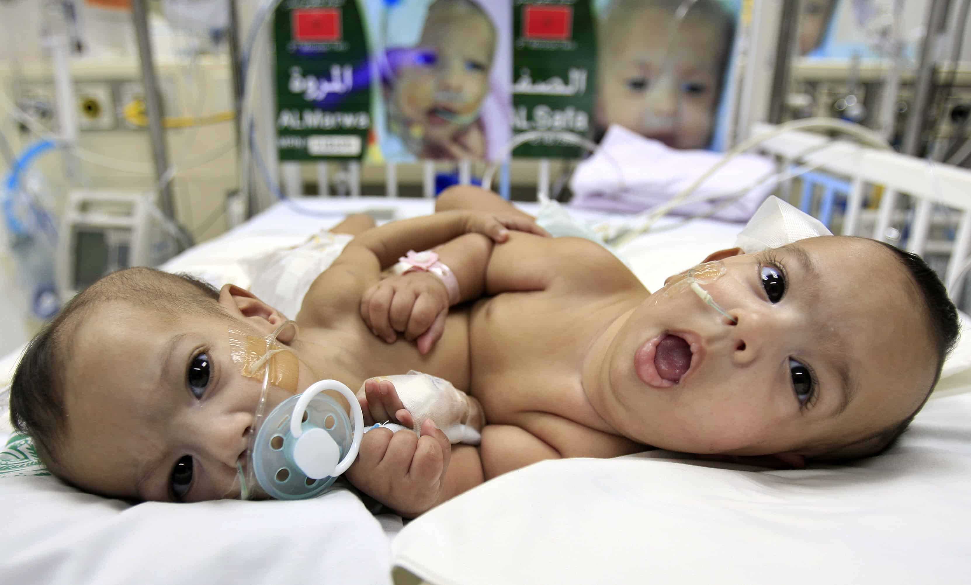 Conjoined Twins Walking: The Science Behind Their Incredible Feat - xgeq094